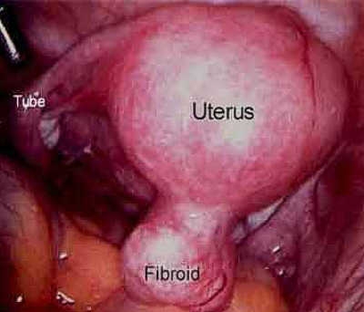 imagine cu fibrom uterin